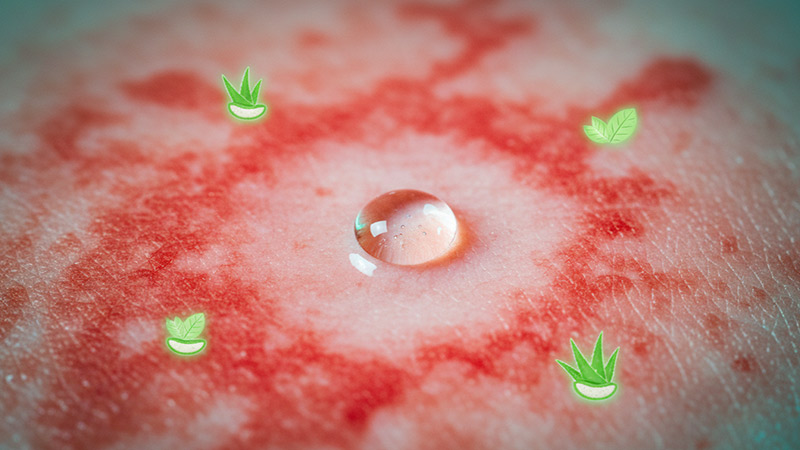 ترکیبات شوینده درمانی پسوریازیس